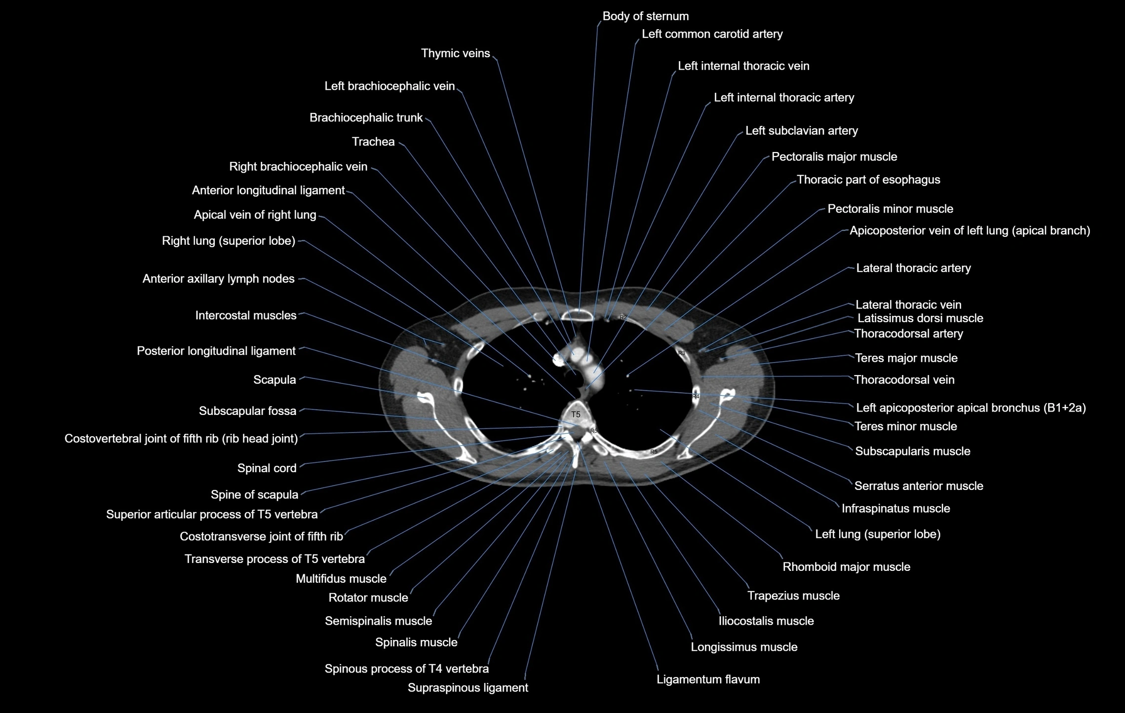 CT chest (thorax) soft tissue window labelled axial cross sectional anatomy radiology image-00032.webp